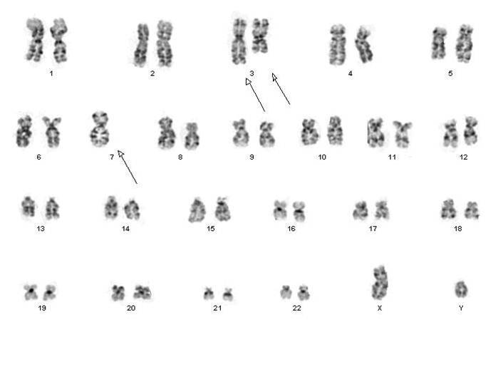 Fig 4 Cytogenetic karyotypic analysis